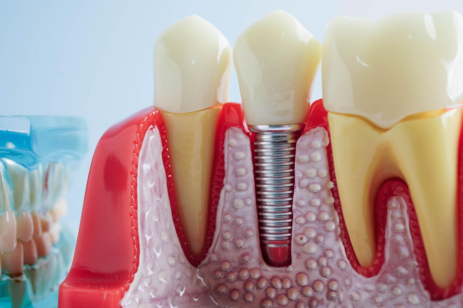 Cross-section model of a tooth implant, showing the screw and surrounding gum and bone.
