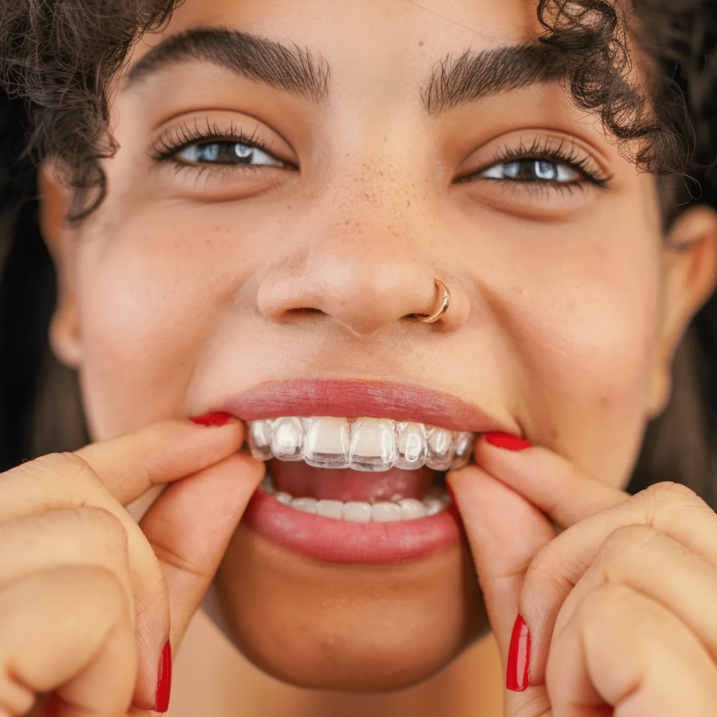 Close-up of a person with red-manicured nails placing a clear dental aligner over their top teeth while smiling.