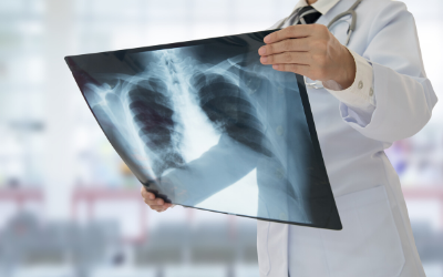 Doctor holding a chest X-ray film in a bright hospital setting