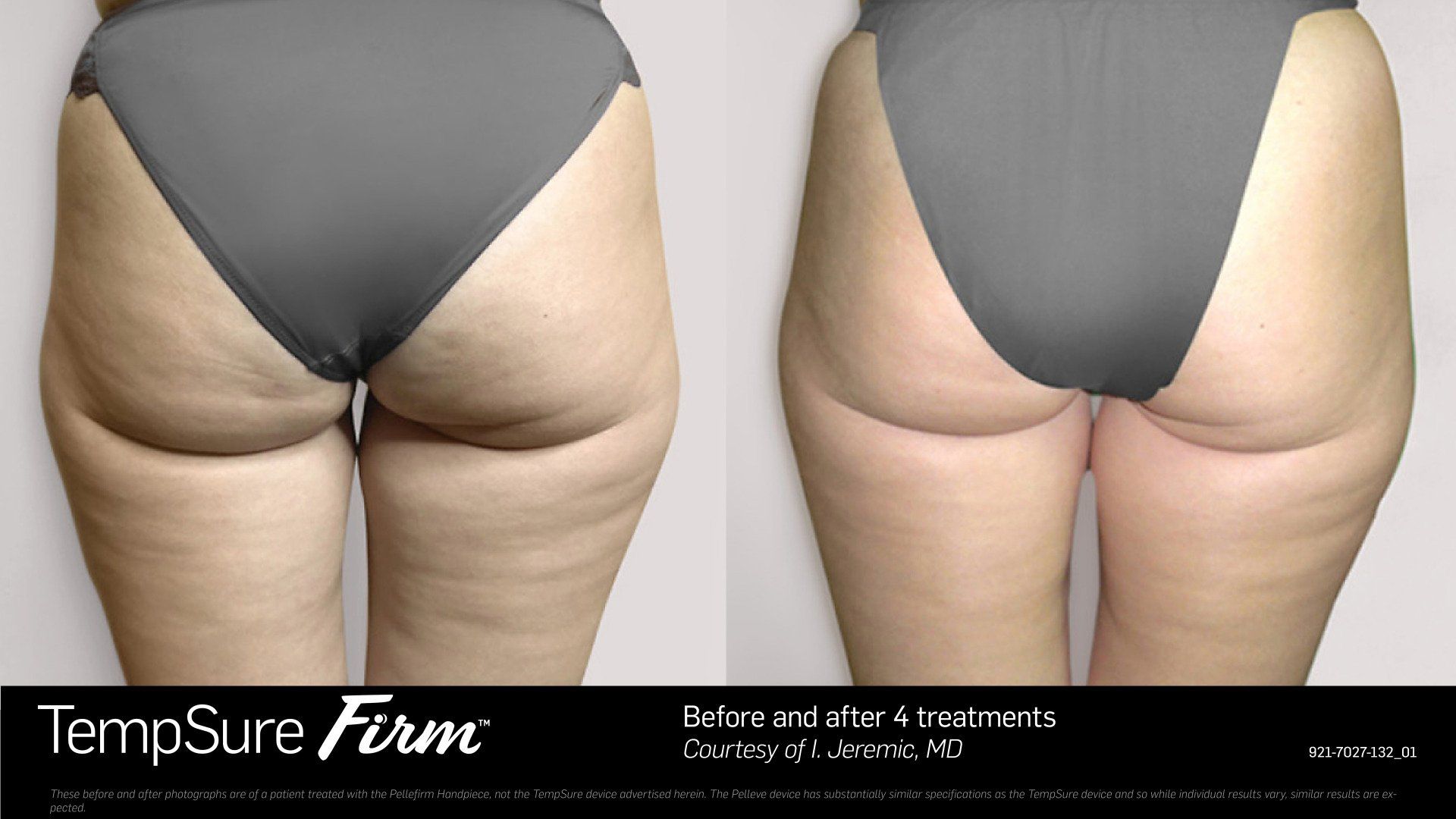 before and after tempsure firm - patient photo