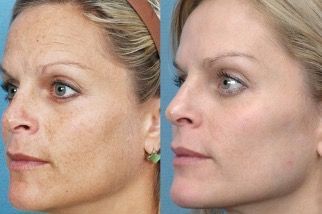 female patient before and after treatment with IPL Photorejuvenation
