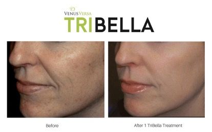 side profile of female patient before and after treatment with IPL for acne