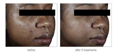 female patient before and after treatment with nanofractional RF microneedling