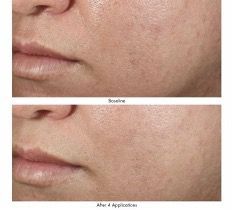 before and after at-home chemical peel
