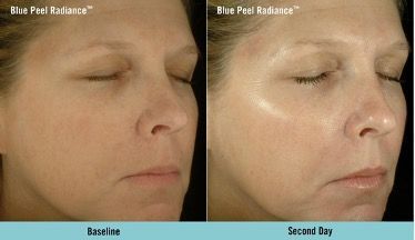 A woman 's face is shown before and after a blue peel treatment.