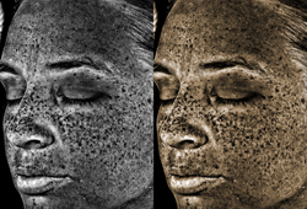 real patient VISIA analysis of skin UV damage