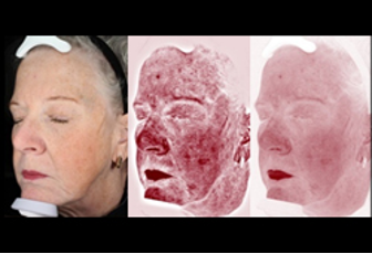 real patient VISIA analysis of skin red spots