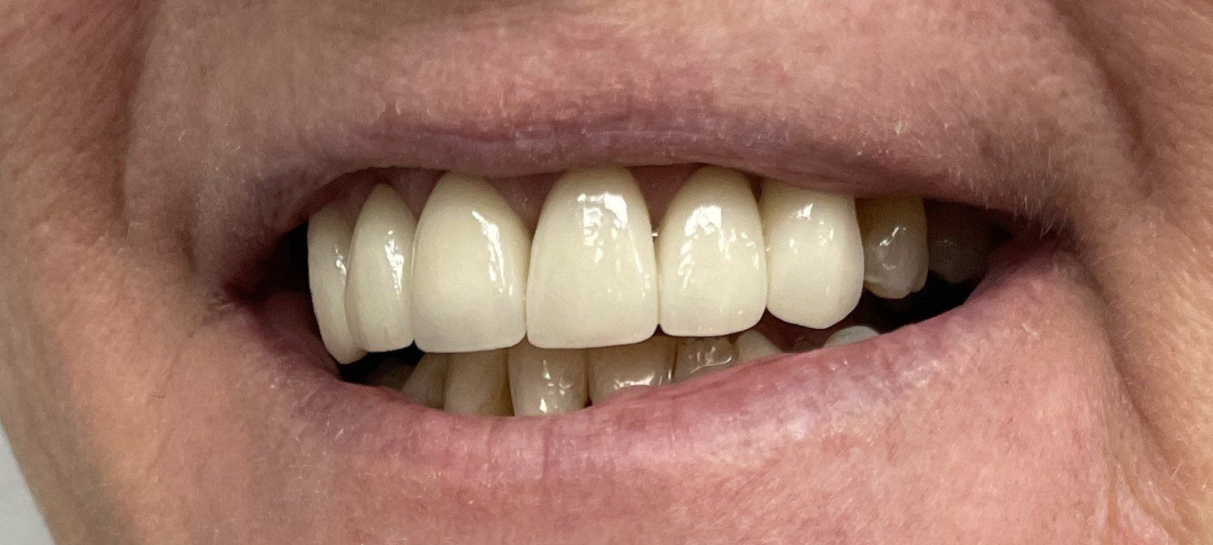 Close-up of a smiling mouth with slightly crooked teeth and pale pink lips