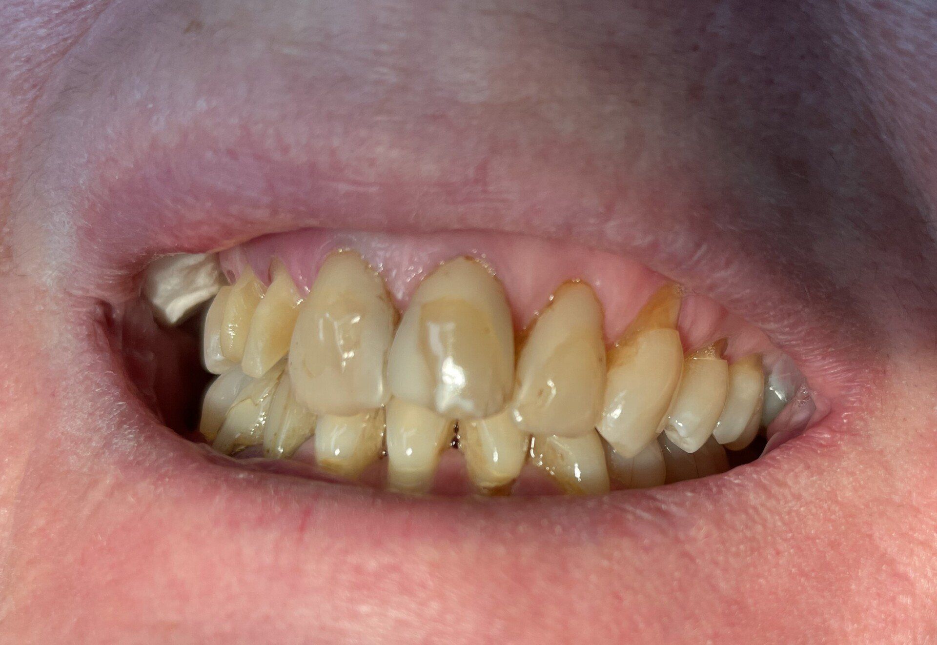 Close-up of a mouth with crowded, yellowed teeth and visible gum recession