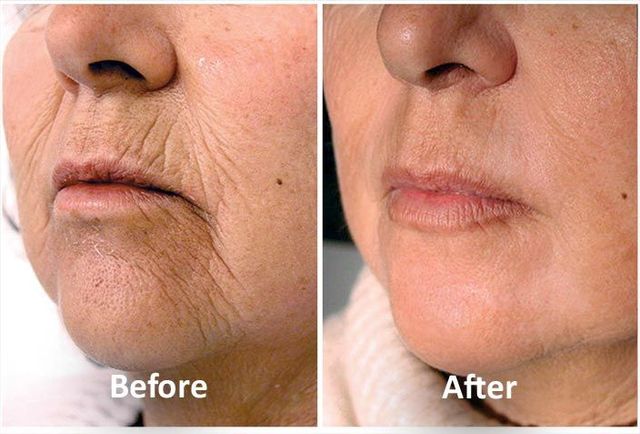 Achieve Firm, Youthful Skin with Laser Skin Tightening in Tysons Corner, VA: Non-Invasive Collagen Boosting Treatments at Body Sculpt Skin & Laser