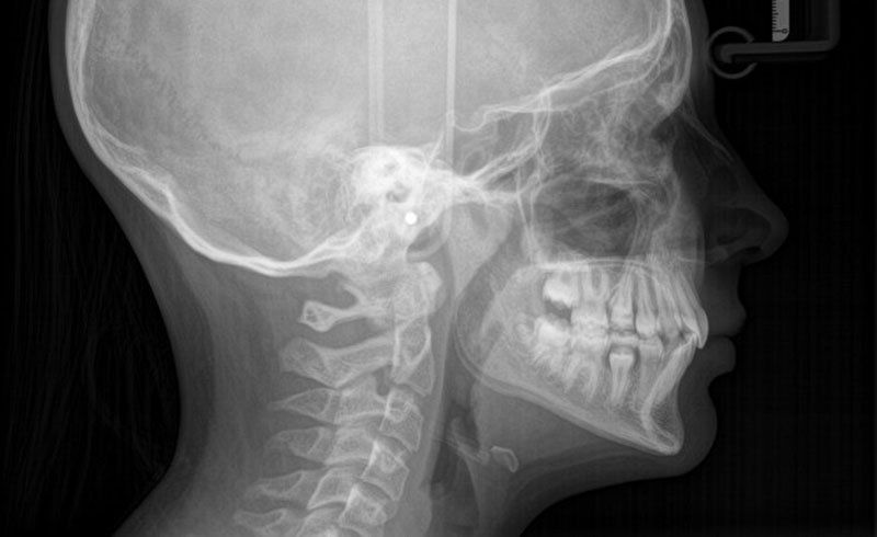 Analisi Radiografiche