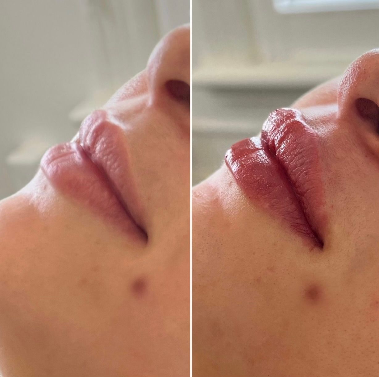 Comparison: Lips before and after lip filler treatment, showing increased volume and shape.