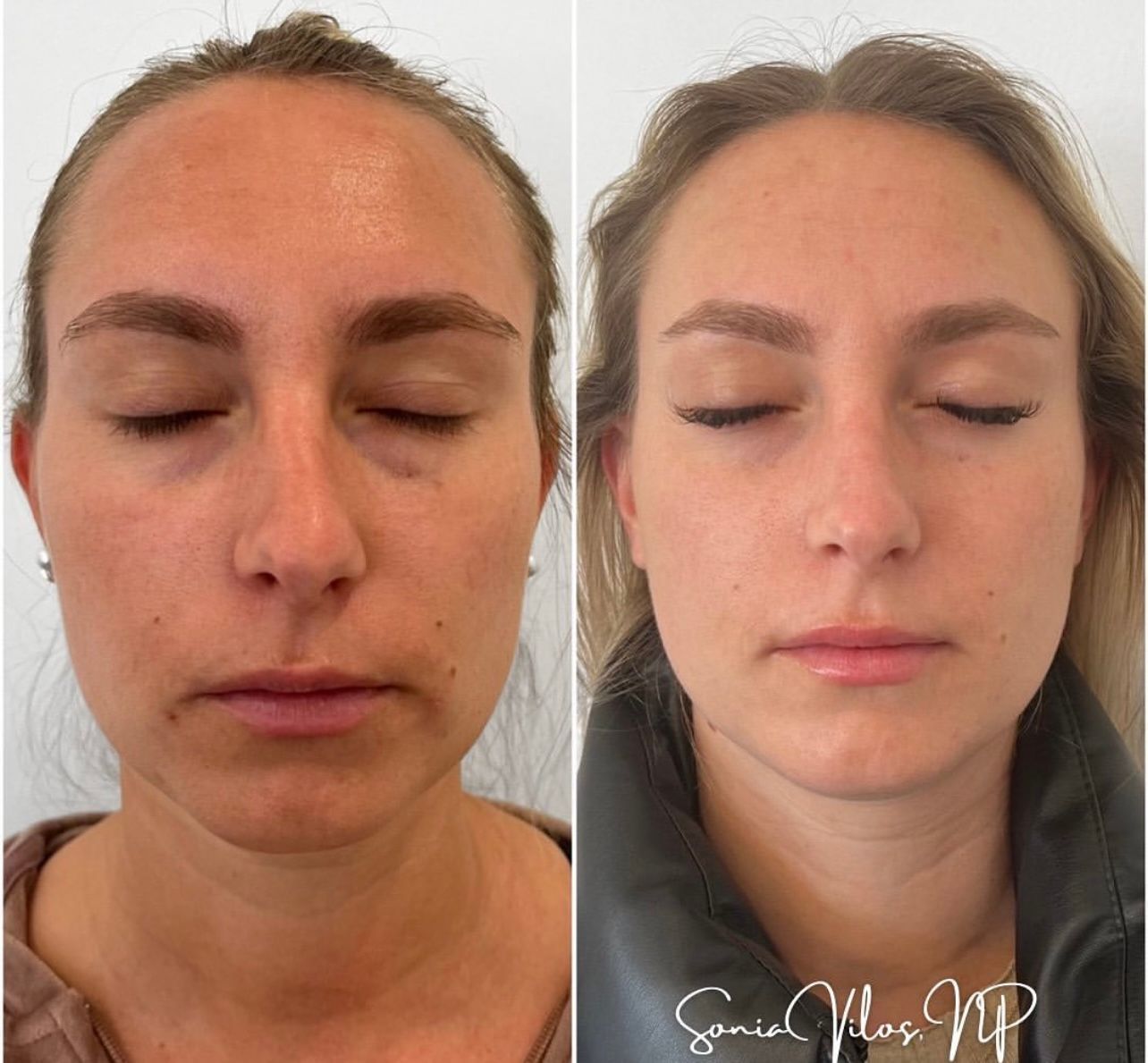 A before and after photo of a woman 's face with her eyes closed.