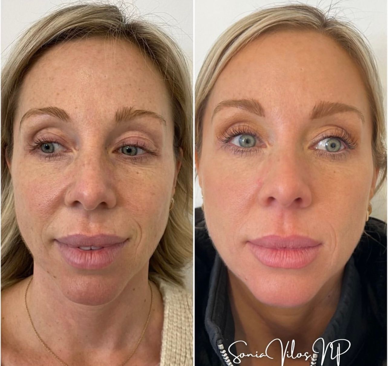 A before and after photo of a woman 's face.