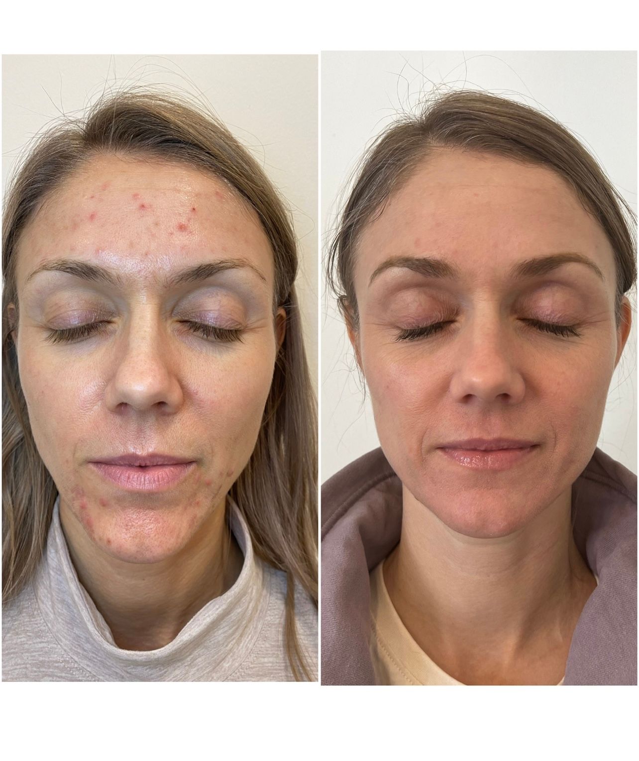 A before and after photo of a woman 's face with acne.