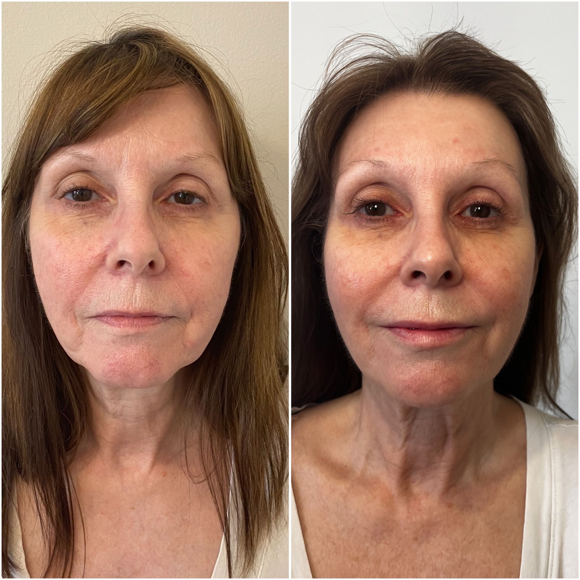 Dermal filler restoration before and after results at Bespøke by SkinAlchemy