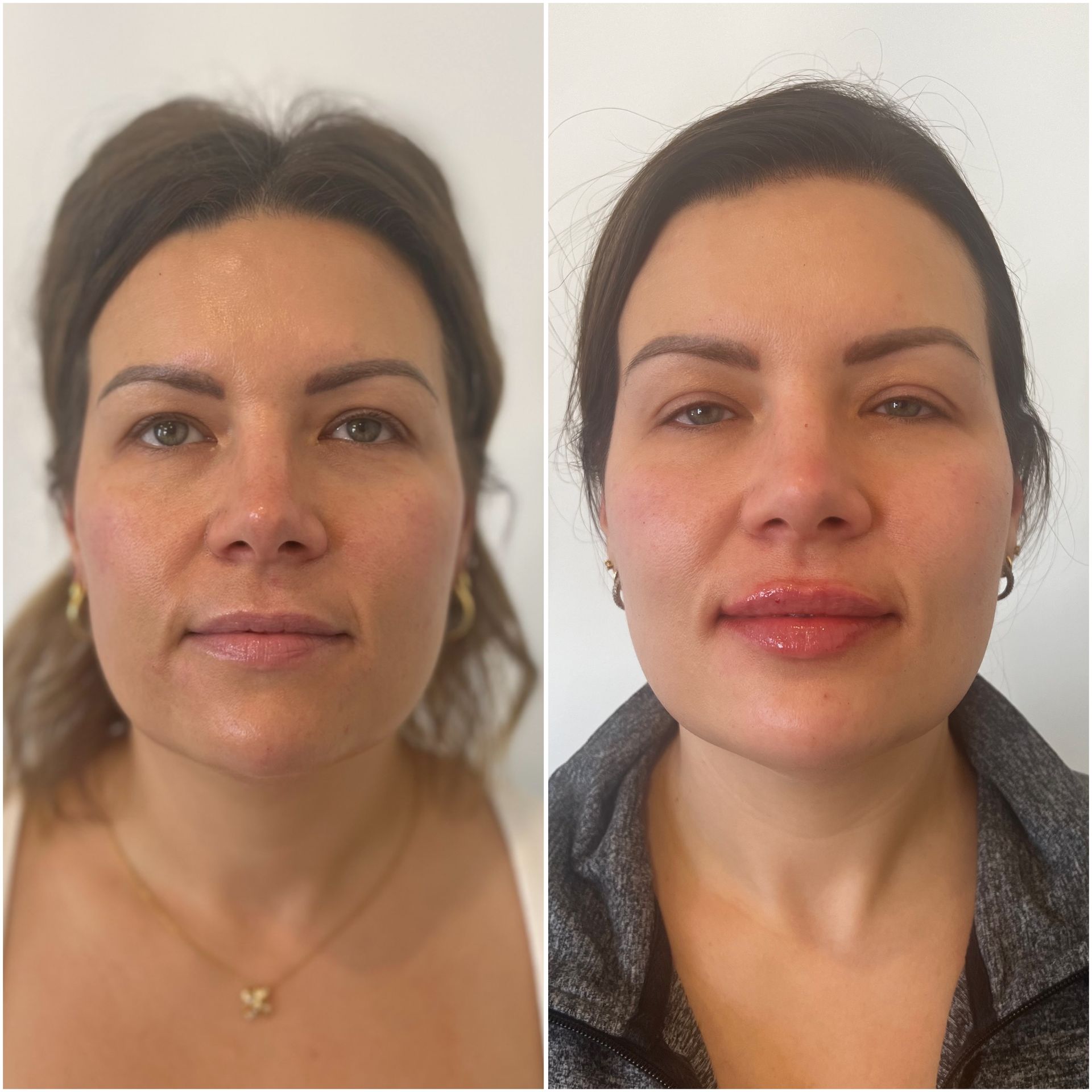 Before-and-after facial comparison: woman with fuller lips and cheeks.