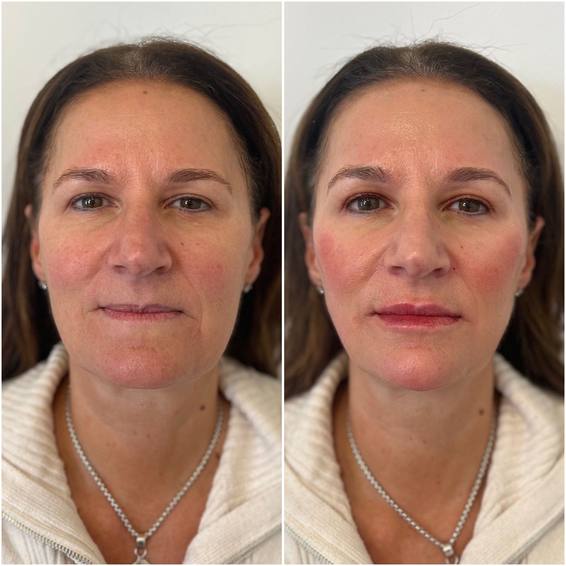 Side-by-side photos of a woman's face, showing a before and after cosmetic treatment, with fuller lips and enhanced cheeks.