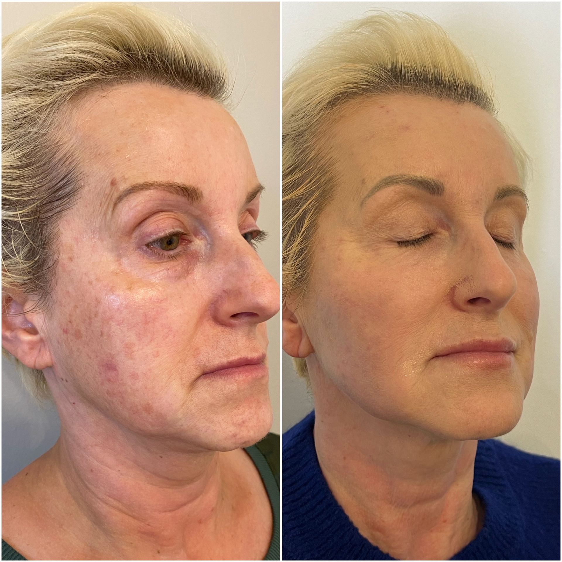 A before and after photo of a woman 's face.