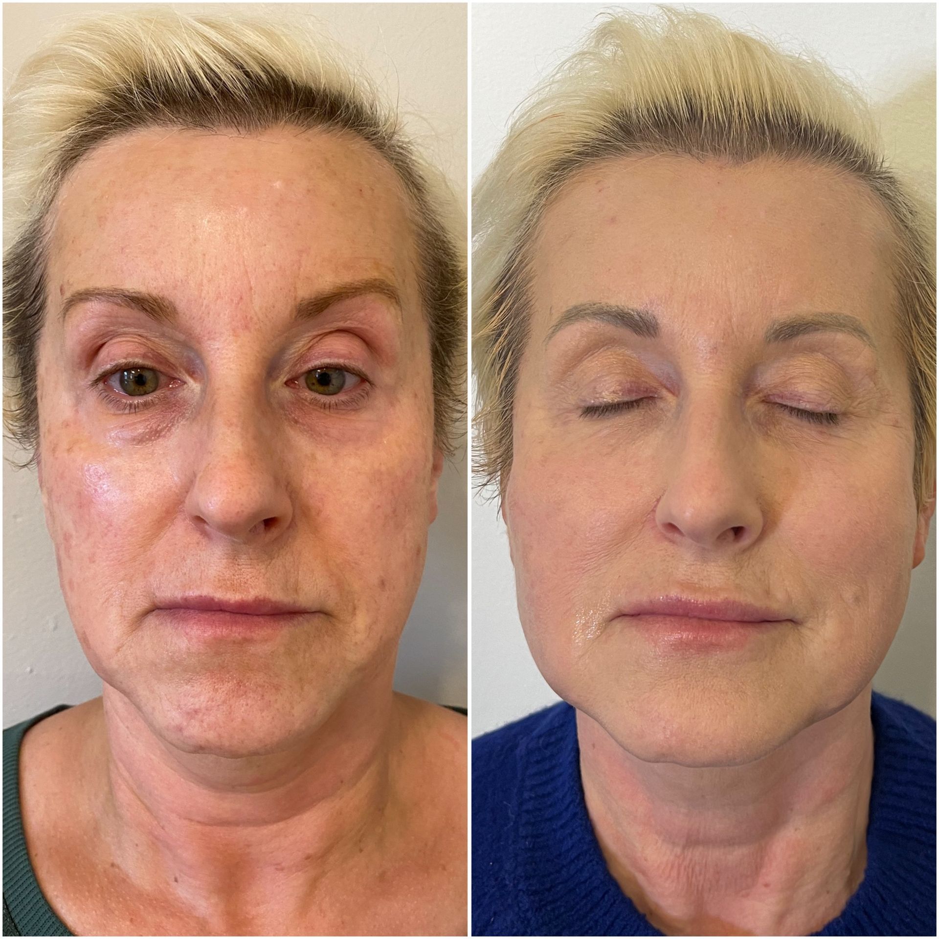 A before and after photo of a woman 's face with her eyes closed.