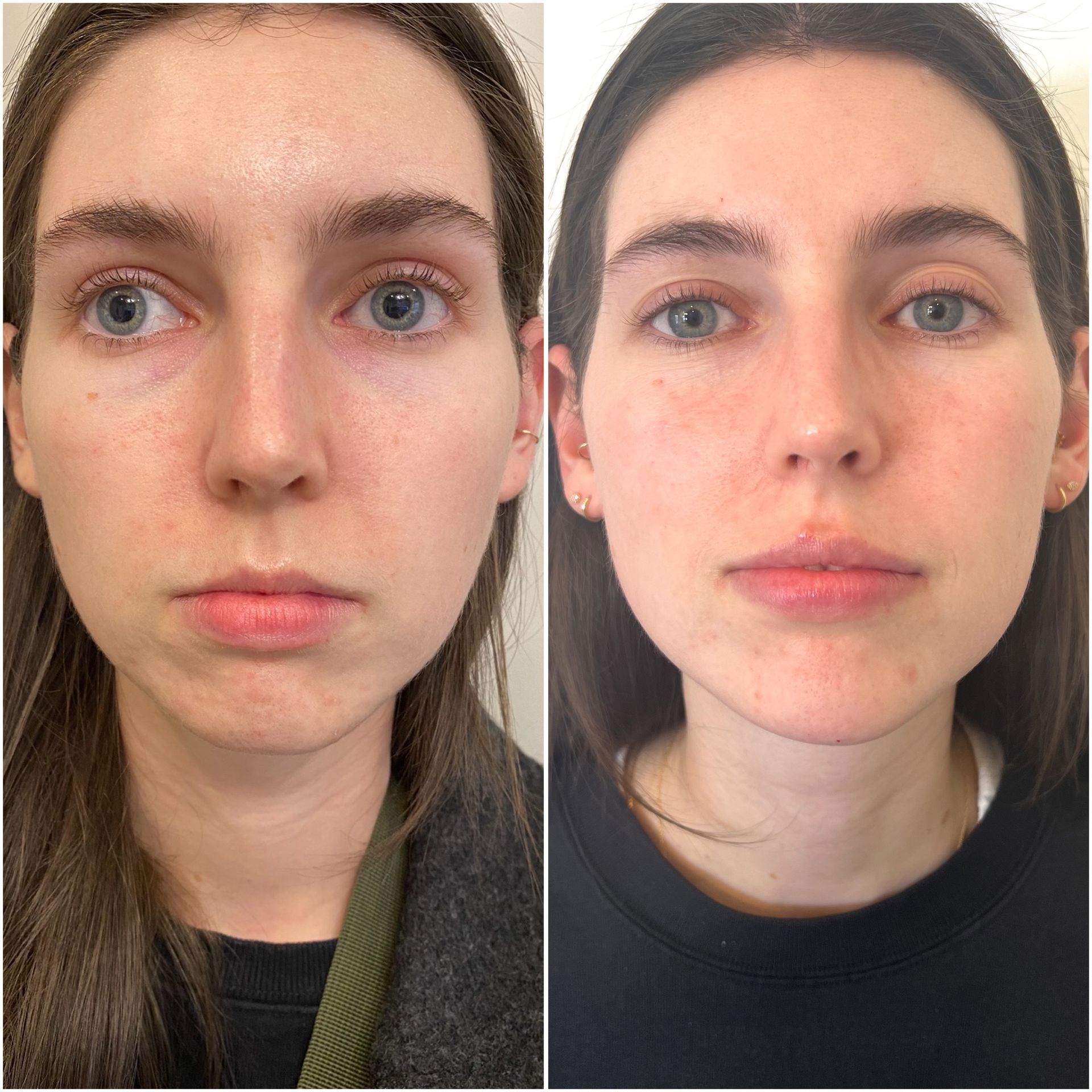 Two side-by-side facial photos: Left has a less defined jawline. Right photo shows a more defined chin and fuller lips.