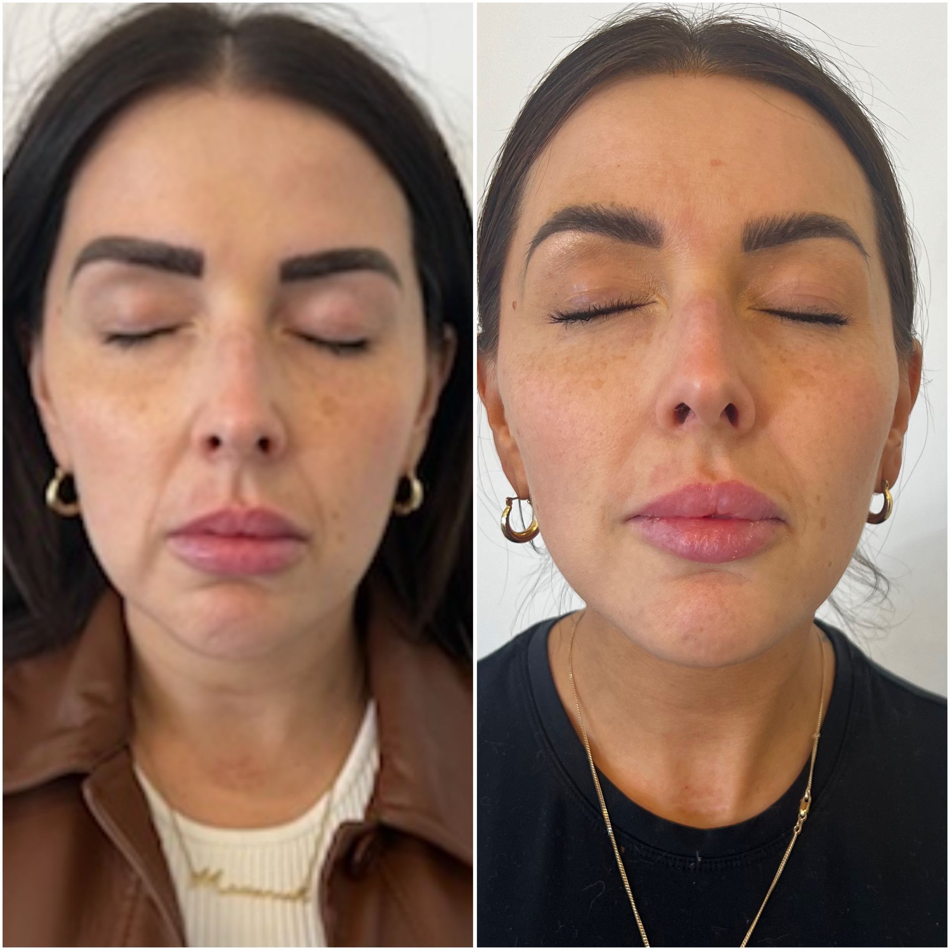 Before and after close-up photos of a person's face showing facial rejuvenation.