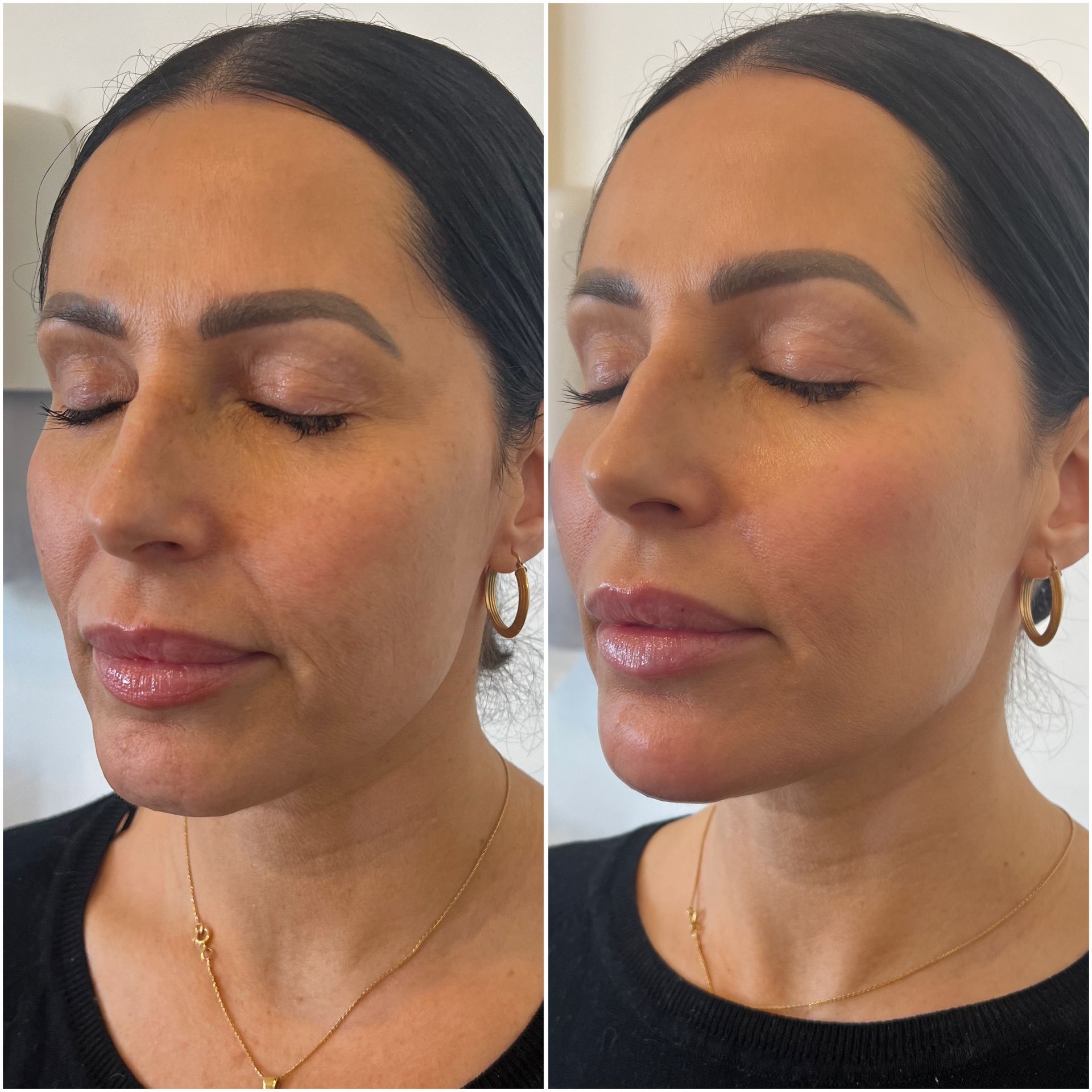 Natural facial rejuvenation results from nurse practitioner-led structural treatments.