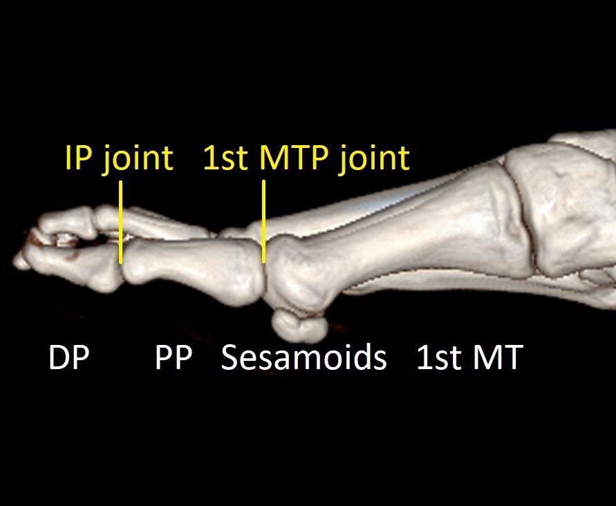 Big Toe (1st MTP) Fusion Dr Ben Beamond Adelaide