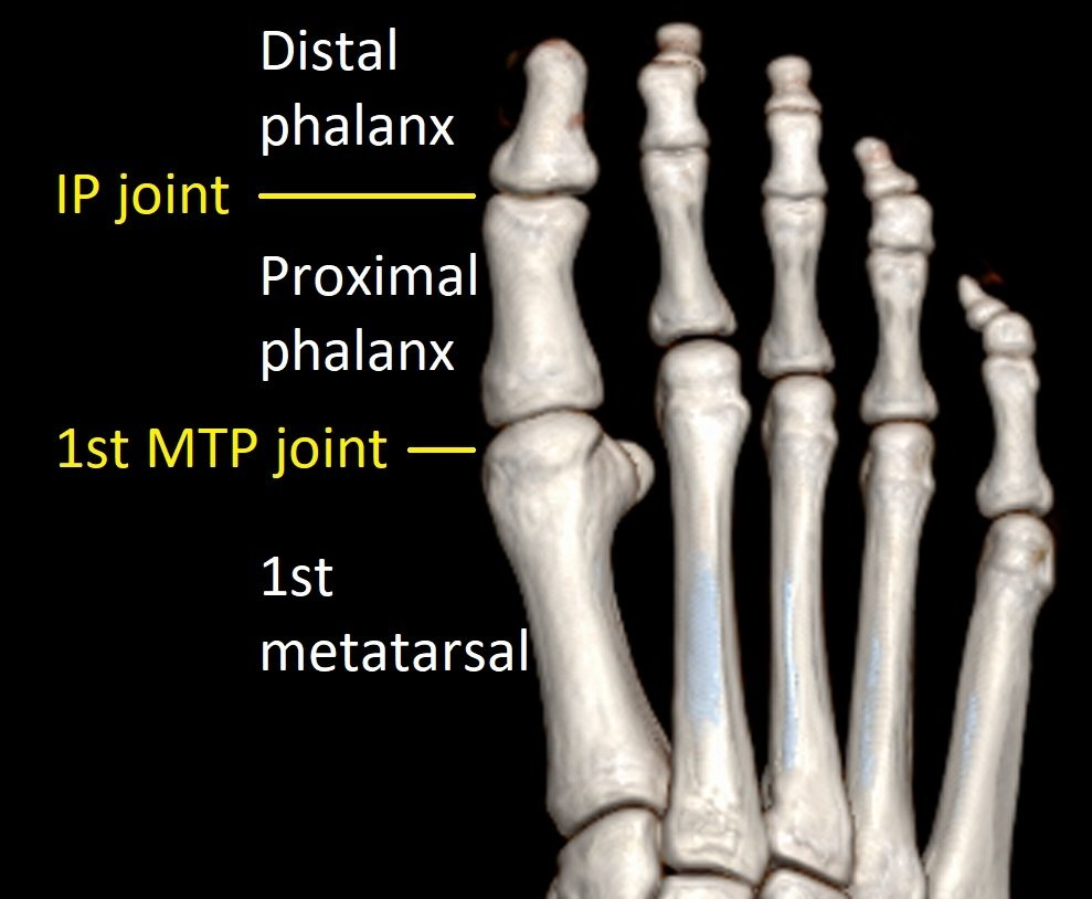 Big Toe (1st MTP) Fusion Dr Ben Beamond Adelaide
