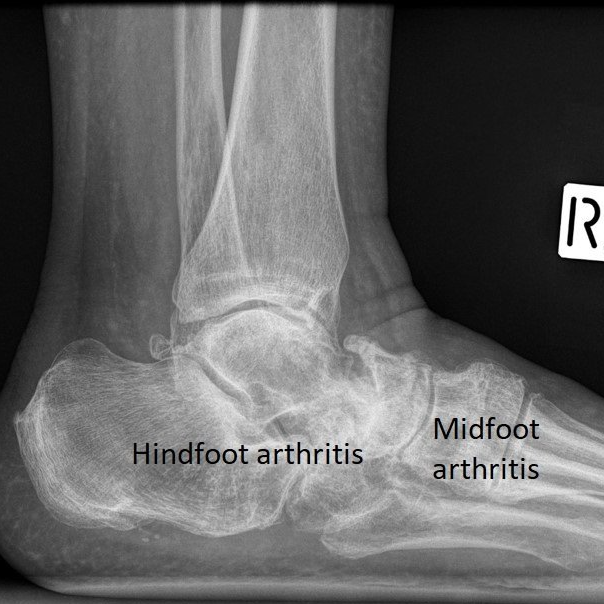 Foot Arthritis Dr Ben Beamond Adelaide