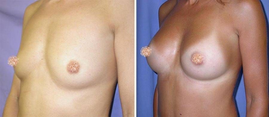 esempio 4 di seno sottoposto a mastoplastica di aumento