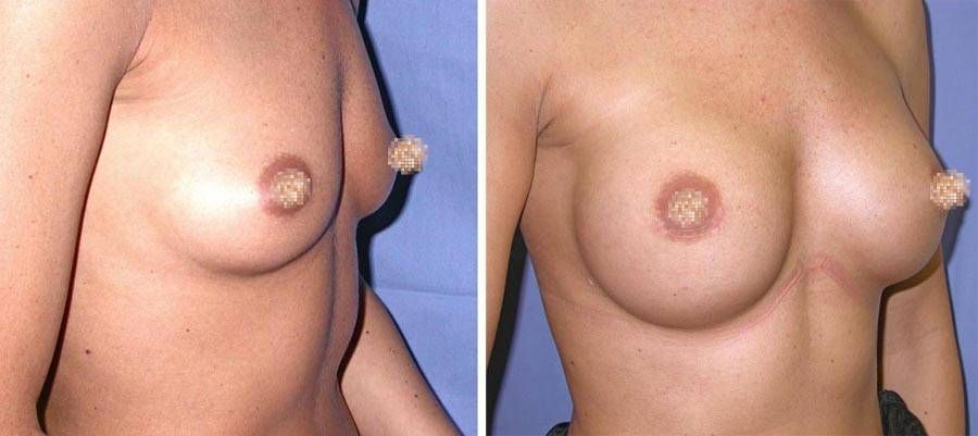 esempio 6 di seno sottoposto a mastoplastica di aumento