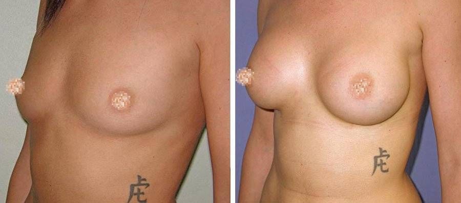 esempio 1 di seno sottoposto a mastoplastica di aumento