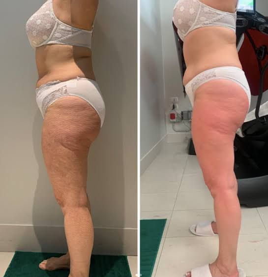 Two side-by-side photos of a person in underwear; before and after cellulite treatment, with skin redness visible in after photo.