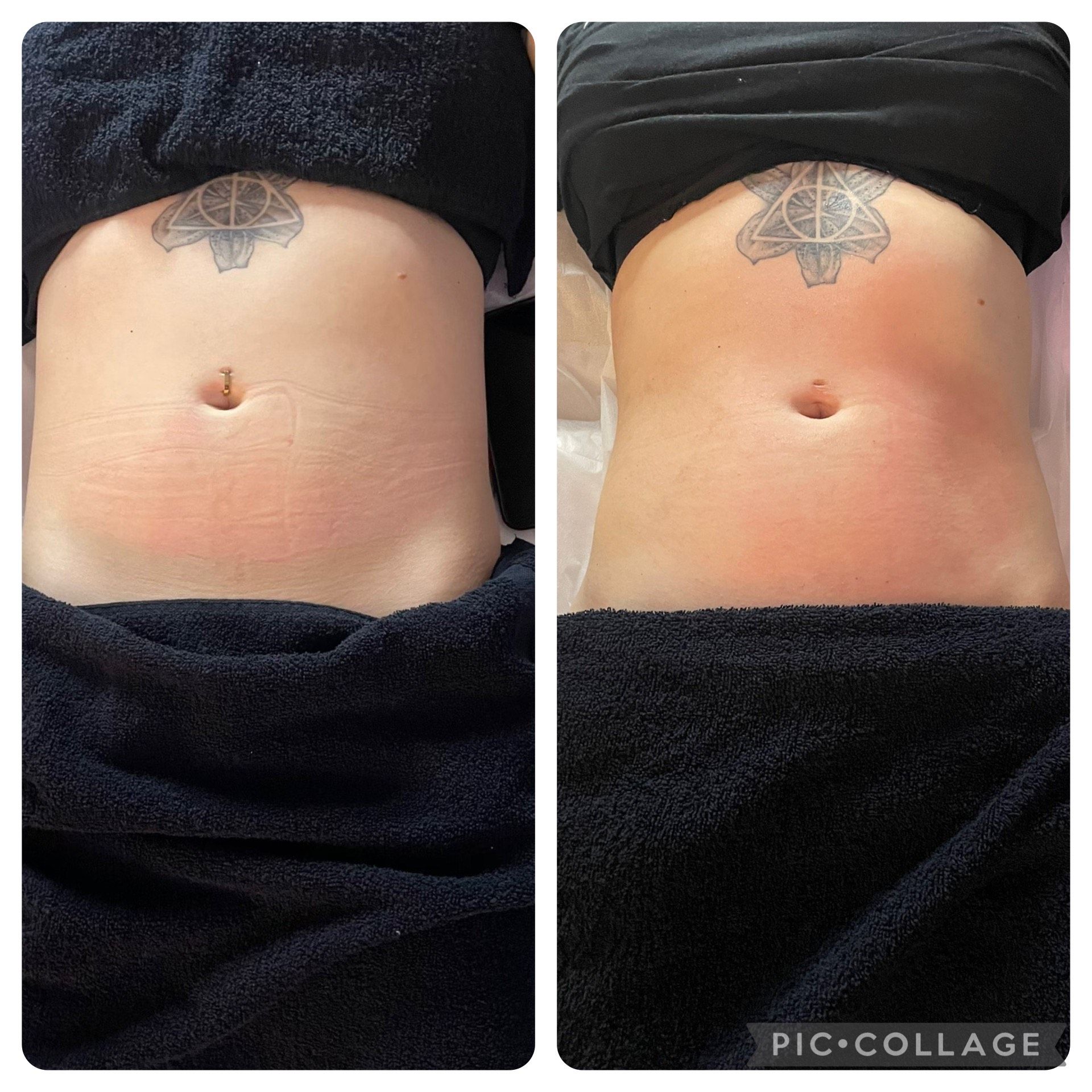 Two side-by-side abdominal views. The abdomen on the left shows stretch marks, while the right appears smoother. A tattoo is visible.