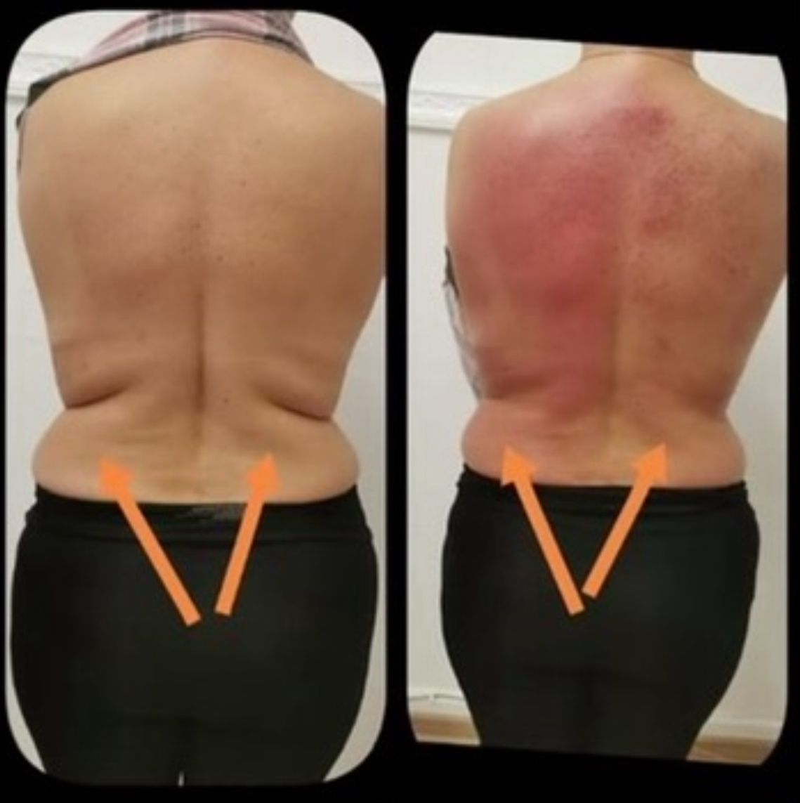 Two photos of a person's back. The right shows red skin. Orange arrows point to the lower back area.