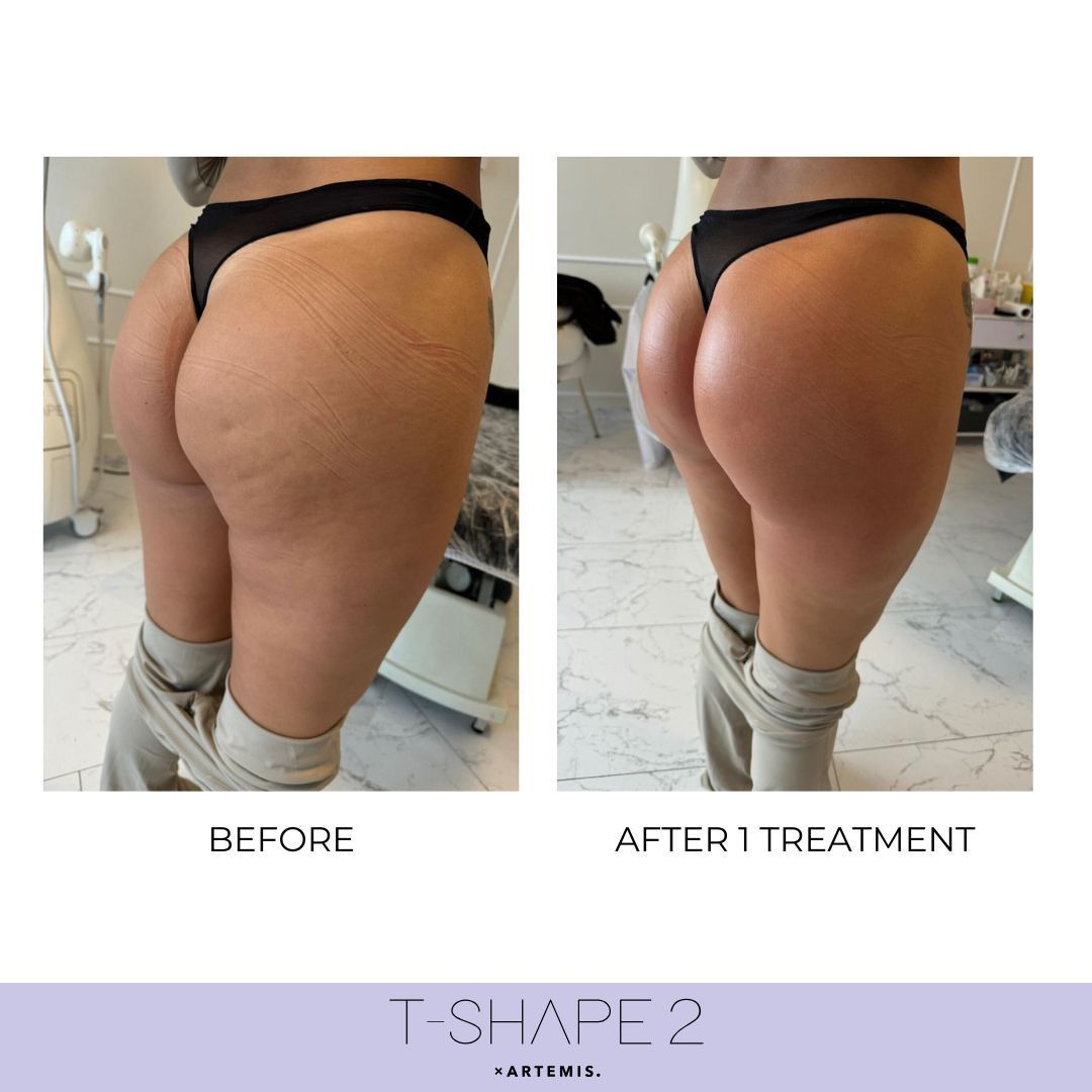 Side-by-side comparison of woman's buttocks before and after T-SHAPE 2 treatment, showing cellulite reduction.