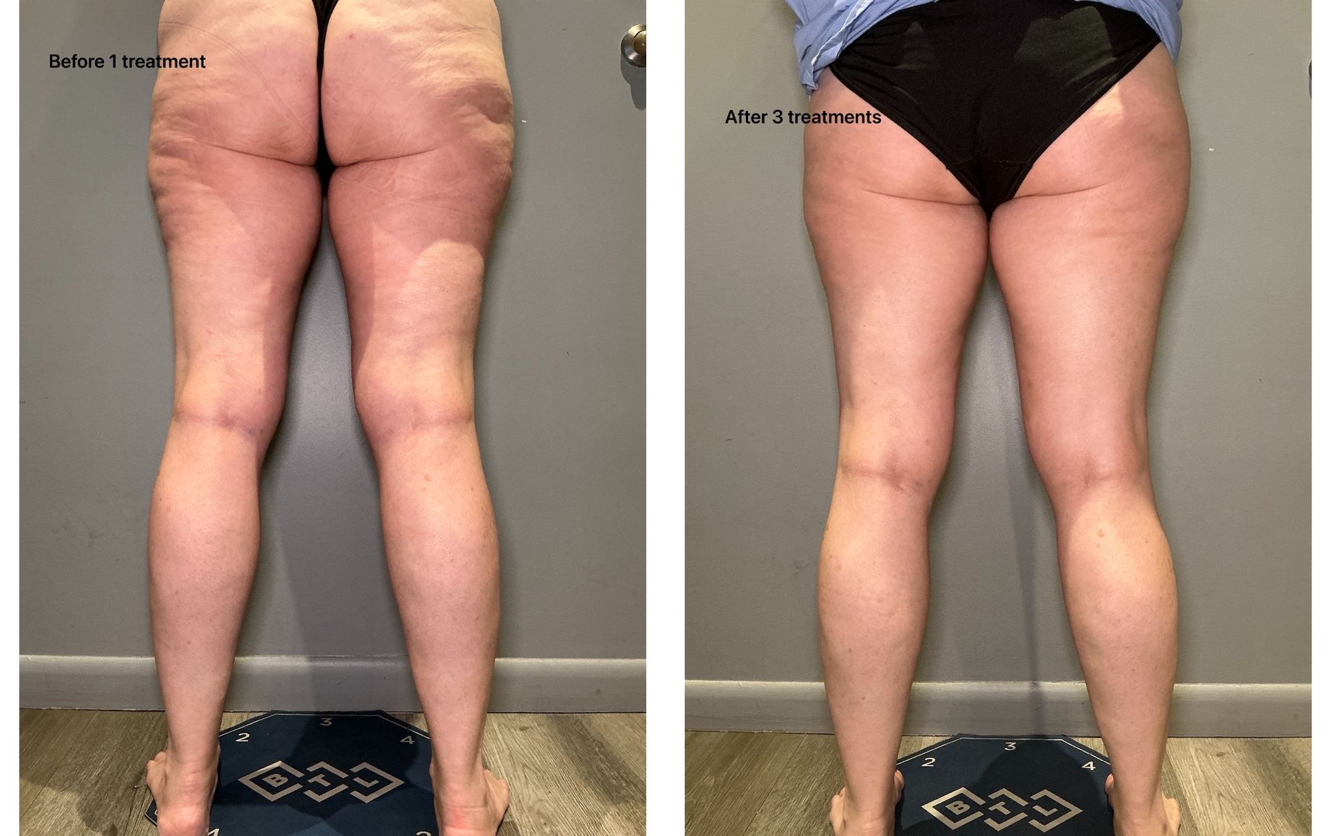 Before and after shots of legs, showing reduced cellulite after treatment.