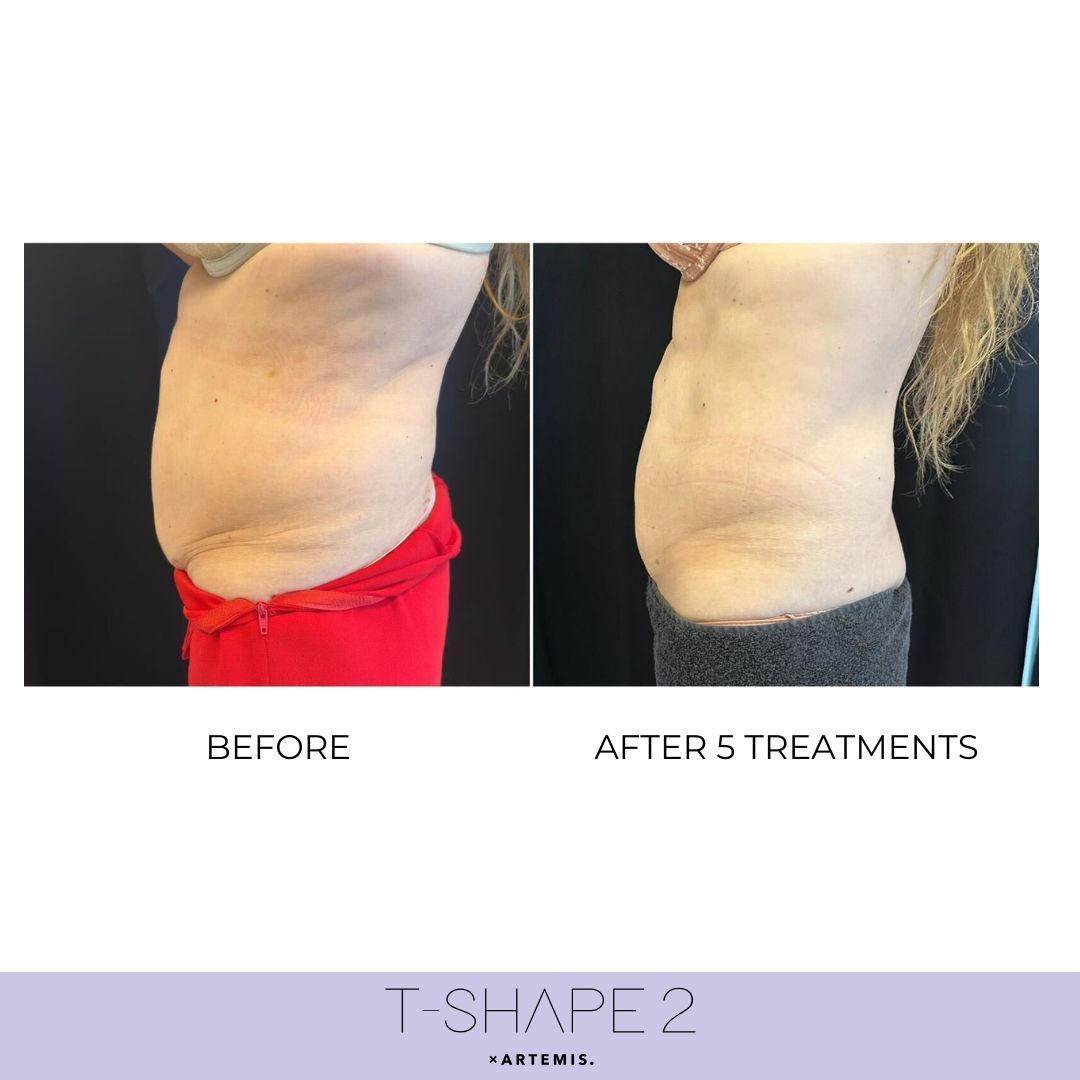 Before and after of a person's abdomen, showing a reduction of fat after five T-SHAPE 2 treatments.