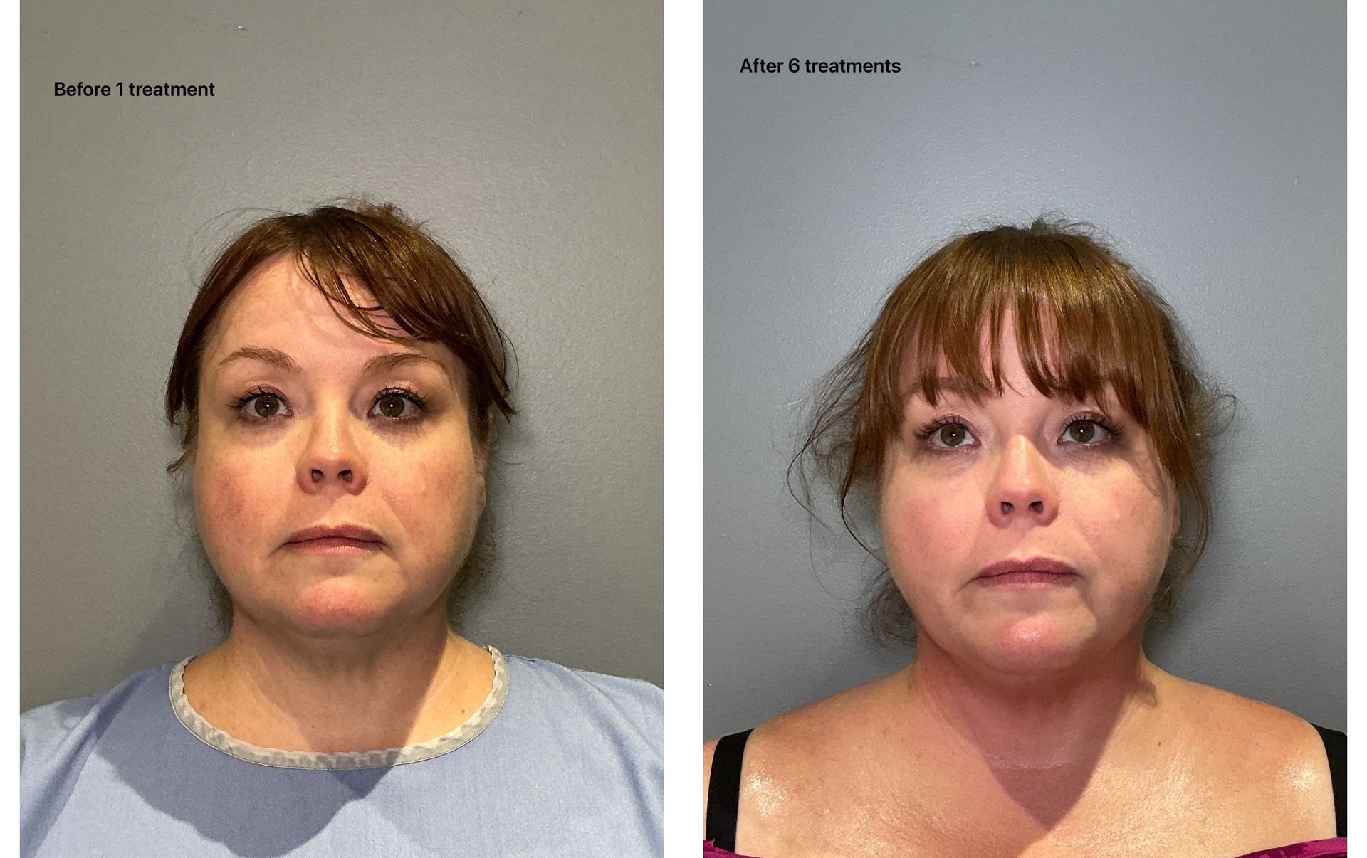 Two photos side-by-side: before and after. Woman's face with similar expression. Before photo has blue top, after has black top.