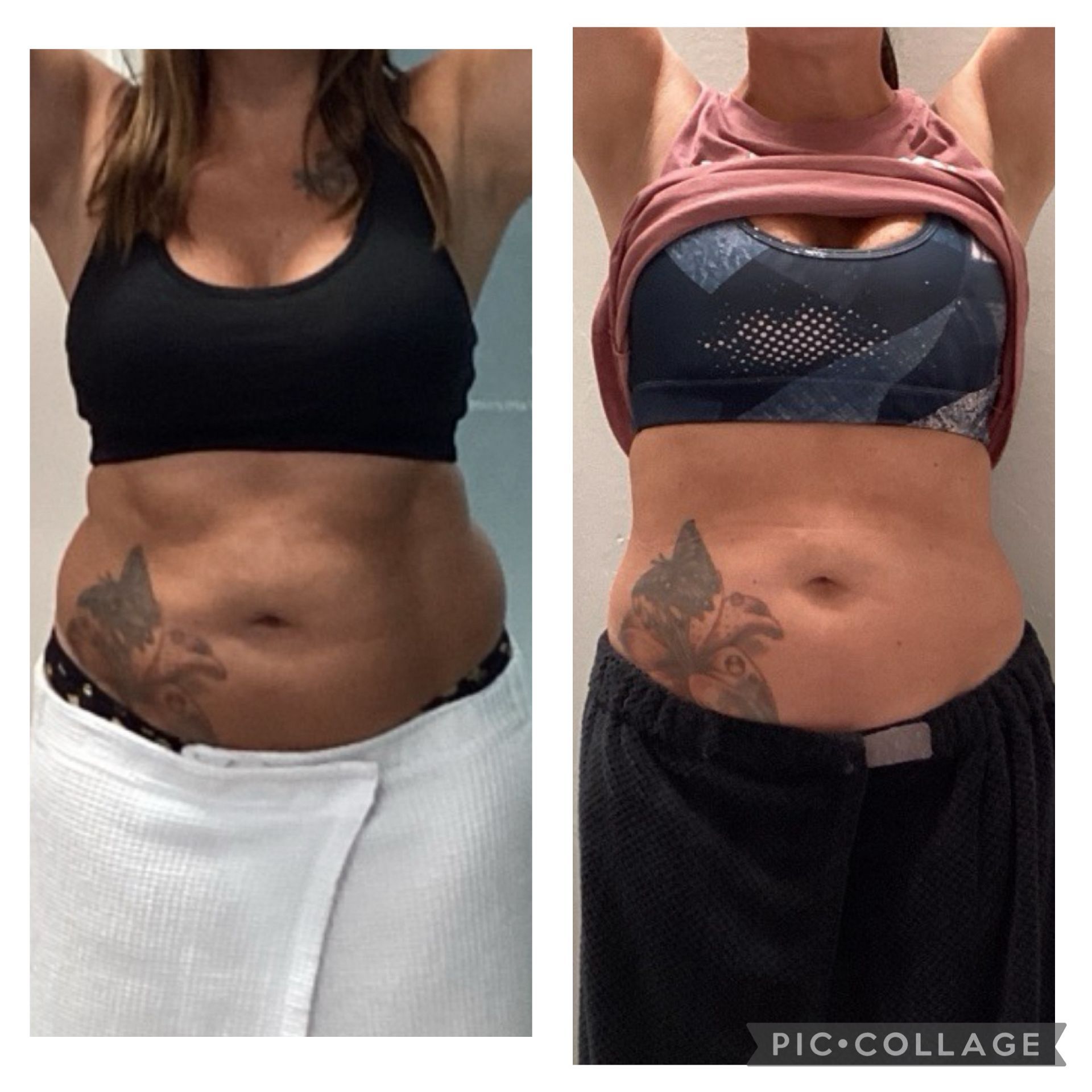 Side-by-side comparison of a person's torso. Left side: towel wrapped, right side: black shorts, visible midsection, possibly after treatment.