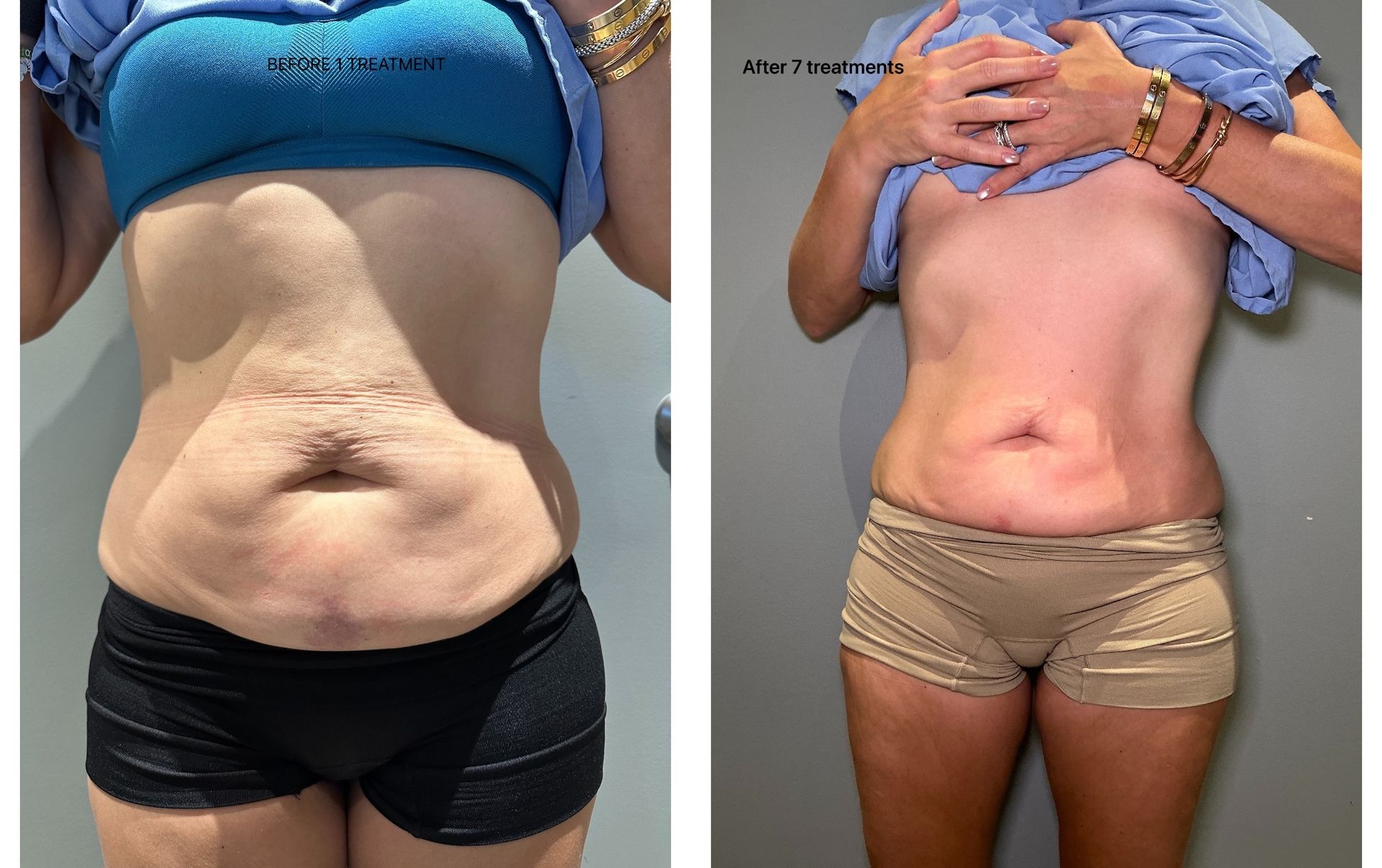 Two photos: abdomen before and after a treatment. Visible fat reduction, improved skin tone.
