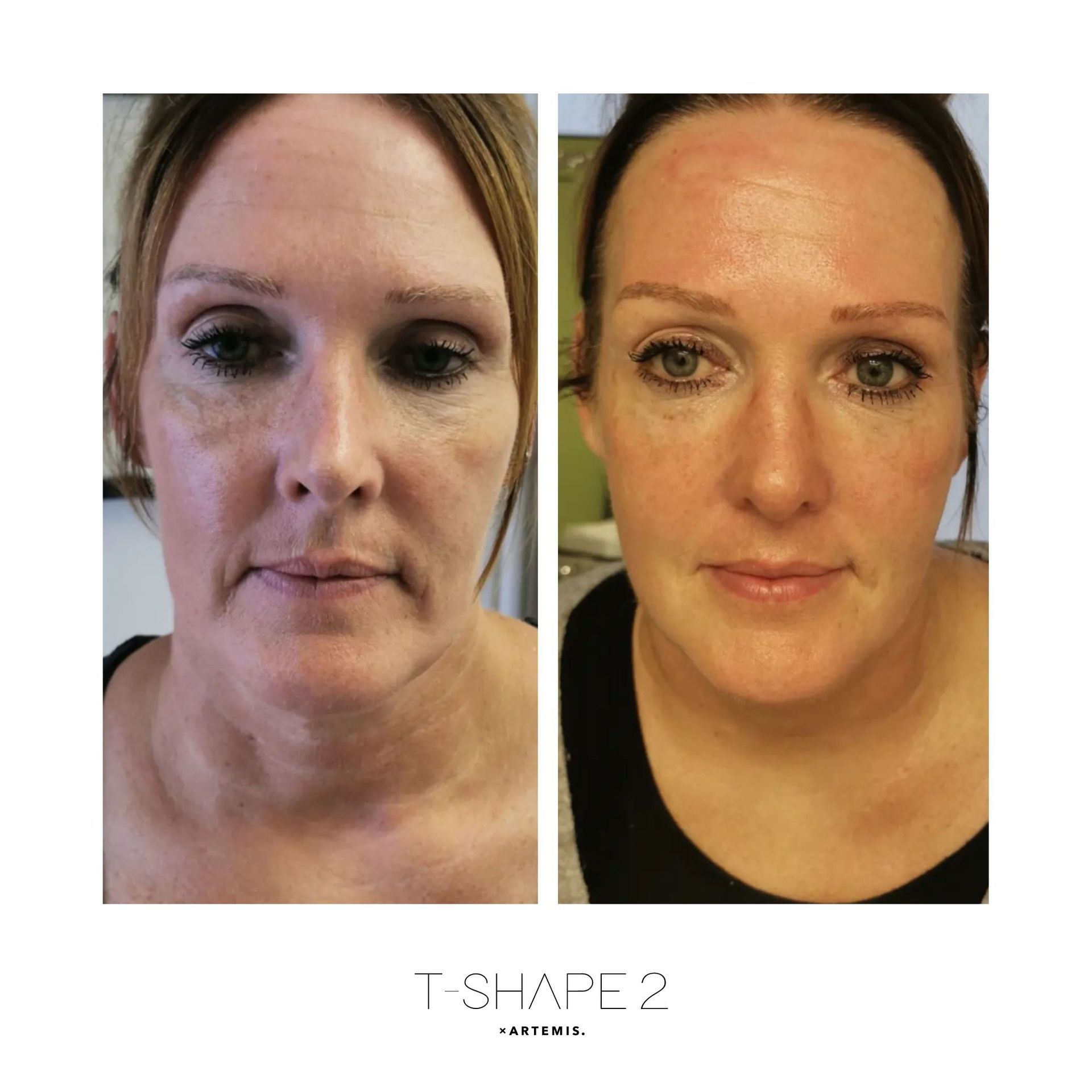 Side-by-side comparison of a person's face. Left side shows wrinkles and sagging skin, right side shows smoother skin.