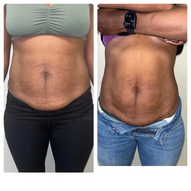 lipo c shot before and after Liquid | Hiram, GA Ipamorelin vs CJC-1295: Complete Glowy Skin Please Select: Box Only/ Push Set:Box Only/No set