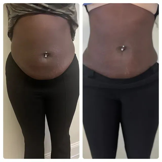does lipo c shots work Liquid Lipo, PCDC Can Lipo C Injections Help