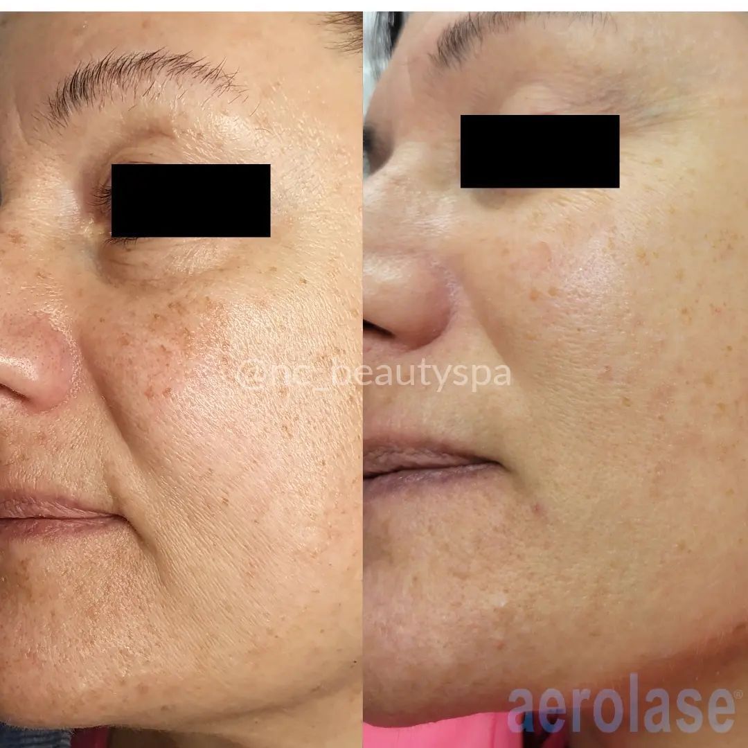 A before and after photo of a woman 's face
