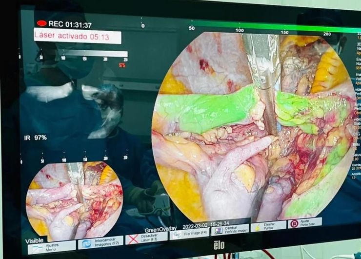 Monitor de quirófano mostrando un procedimiento de cirugía con tecnología láser para hemorroides o fístulas - Dr. Marco Boca.