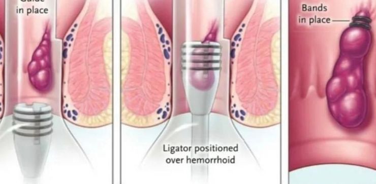 Diagrama médico explicativo del tratamiento de ligadura con banda elástica para hemorroides internas