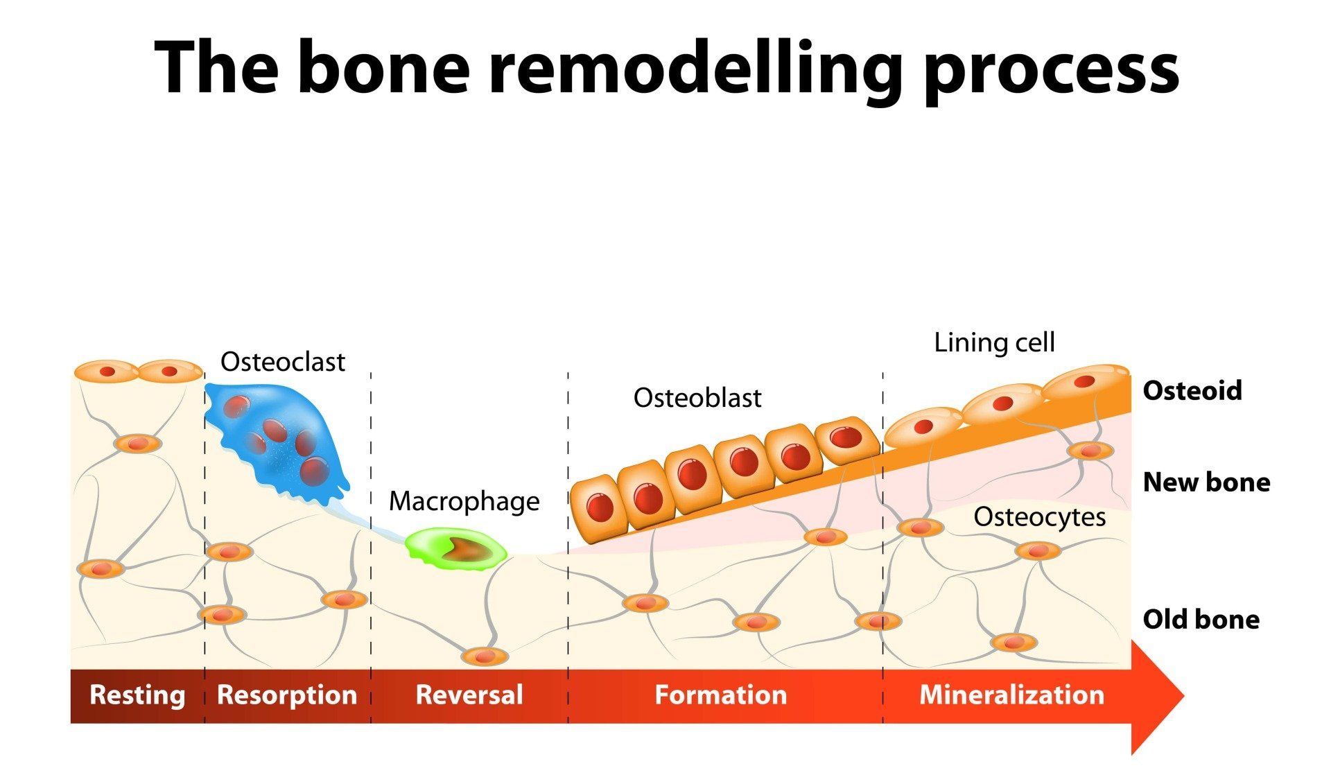 Bone remodelling diagram showing osteoclasts, osteoblasts, and stages from resorption to mineralization.