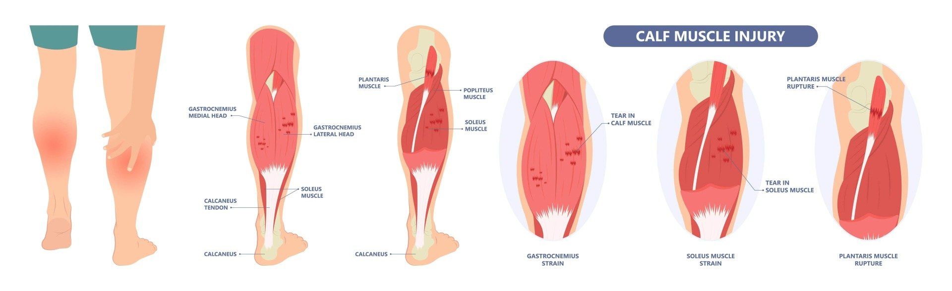 Diagram of a calf muscle showing different grades and sites of muscle injury